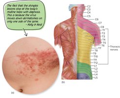 Shingles rash and dermatomal distribution