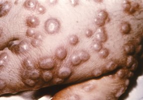 Smallpox pustular rash