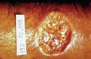 Leishmaniasis skin lesion