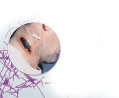 Cutaneous anthrax with black eschar