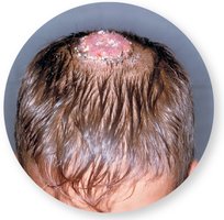 Ringworm lesion on scalp