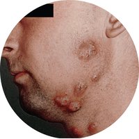 Ringworm lesion on face