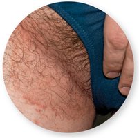 Ringworm lesion on beard area
