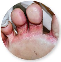 Ringworm lesion on groin