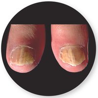 Ringworm lesion on foot