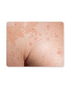 Tinea versicolor on light skin
