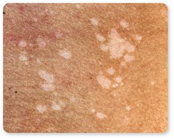 Tinea versicolor on medium skin
