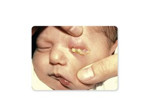 Neonatal conjunctivitis with purulent discharge