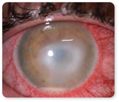 Keratitis with corneal opacity