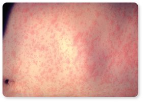 Measles rash on skin