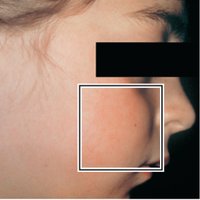 Slapped cheek appearance in fifth disease