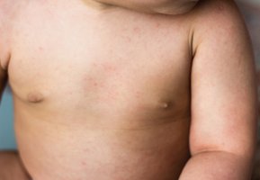 Roseola rash on infant's chest