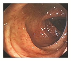 Intestinal pathology in giardiasis