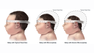 Microcephaly in infants