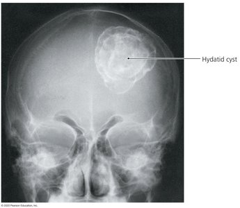 X-ray of hydatid cyst