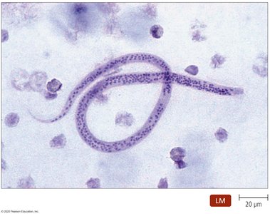 Microfilaria of Wuchereria bancrofti