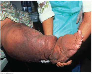 Elephantiasis in a leg