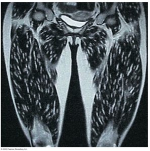 Cysticercosis