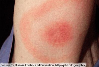 Lyme disease bull's-eye rash