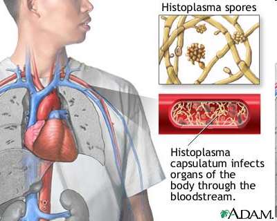 Histoplasma capsulatum infection diagram