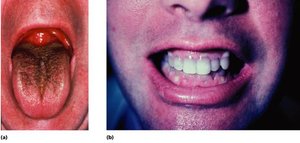 Side effects of antibiotics: opportunistic infection and tetracycline-stained teeth