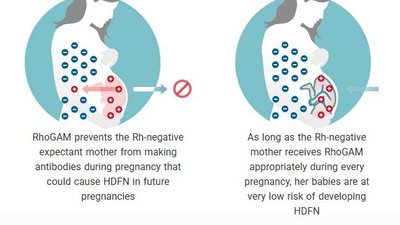 Prevention of HDN with RhoGAM