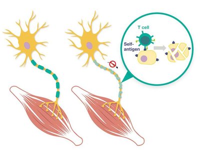 Multiple sclerosis and T cell-mediated myelin damage