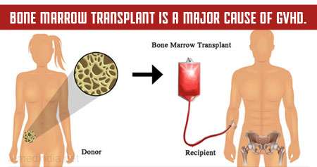 Bone marrow transplant and GVHD