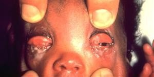 Ophthalmia neonatorum in infant