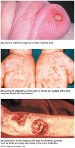 Stages of syphilis: chancre, rash, gummas