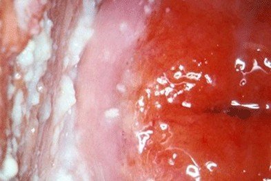 Candidiasis: white patches on vaginal mucosa