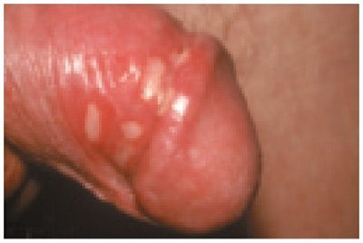 Genital herpes vesicles on penis