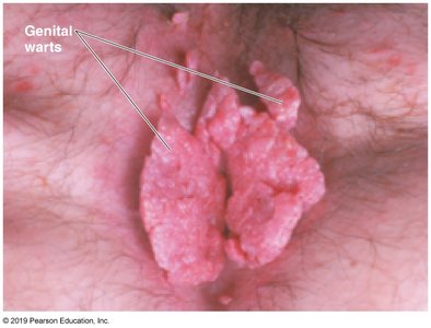Genital warts: large, cauliflower-like lesions