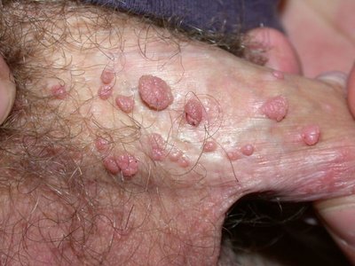 Genital warts: multiple raised lesions