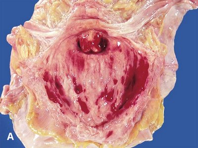 Inflamed urinary bladder in cystitis