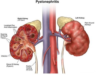 Pyelonephritis: kidney infection and scarring