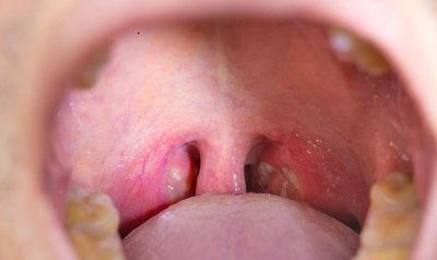 Oral lesions in secondary syphilis