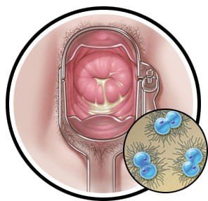 Cervical infection with Neisseria gonorrhoeae