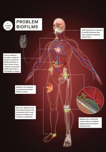 Diagram of biofilm-related health problems in the human body