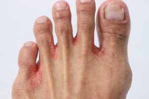 Red, irritated skin between toes due to athlete's foot