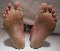Feet with symptoms of athlete's foot