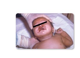 Neonatal herpes simplex infection