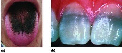 Examples of side effects: black hairy tongue and tooth discoloration