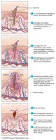 Events of inflammation after a cut
