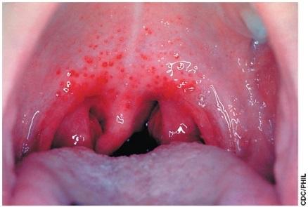 Streptococcus pyogenes infection in throat