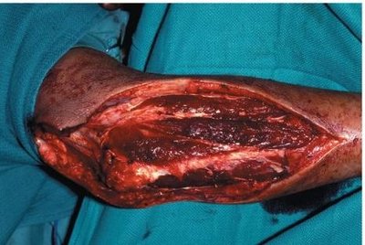 Gas gangrene caused by Clostridium perfringens