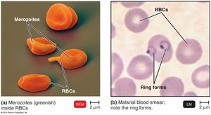 Malaria blood smear with ring forms