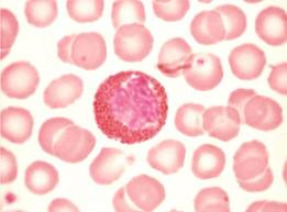 Eosinophil in blood smear (eosinophilia)