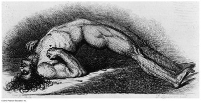 Advanced case of tetanus