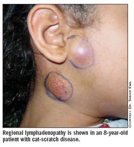 Lymphadenopathy in cat-scratch disease